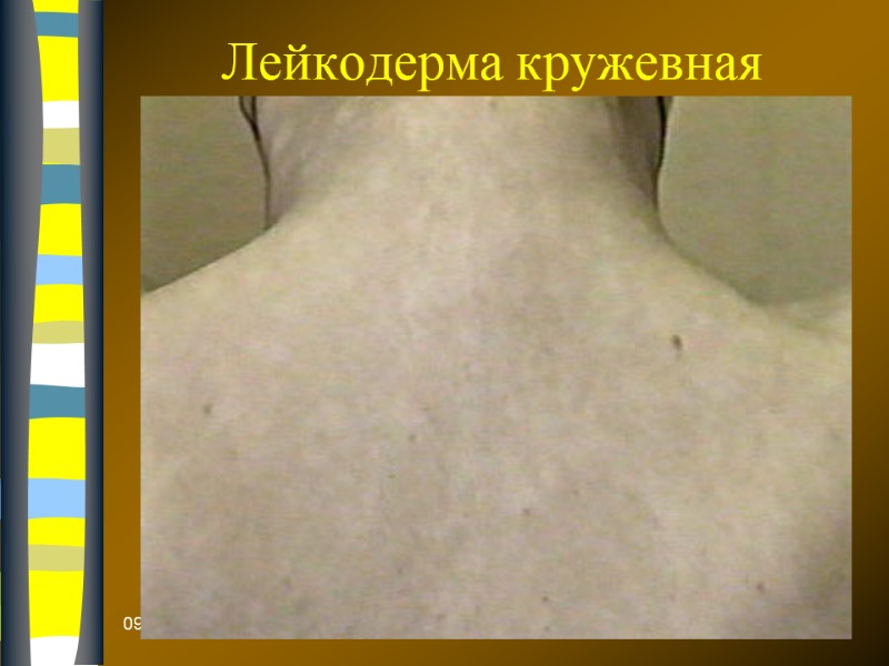 09.12.2017 Лейкодерма кружевная